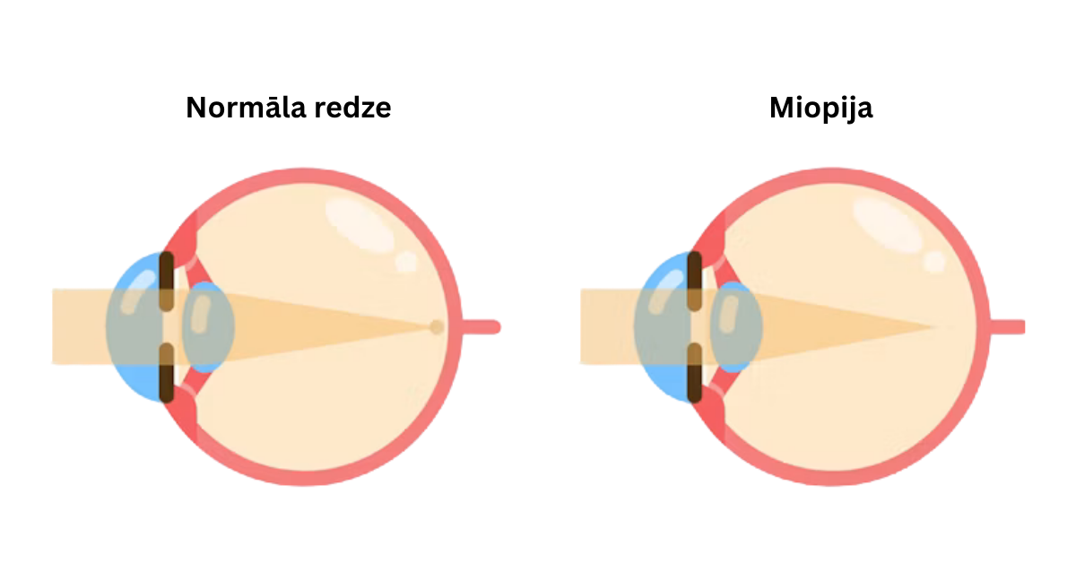 Miopijas kontroles lēcas